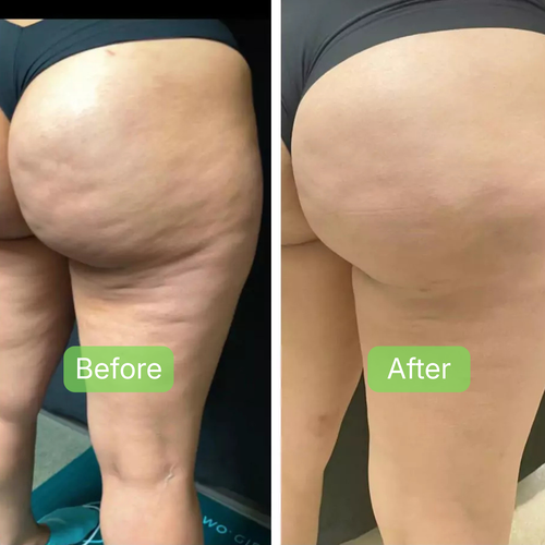 Anti-Cellulite Massage Oil